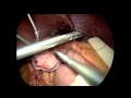 Sages top 21s laparoscopic rouxeny gastric bypass