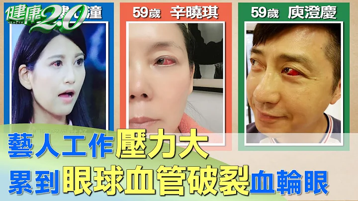 藝人工作壓力大 累到眼球血管破裂血輪眼！ 健康2.0 - 天天要聞