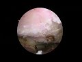 Minimally Invasive Shoulder Surgery- Arthroscopic Monk&#39;s Hood-Type Rotator Cuff Repair (SCOI Row)