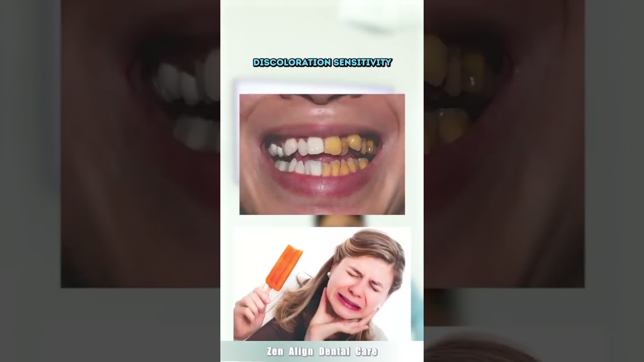 excessive brushing is damaging your teeth | zen align dental care