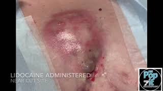 1 chest 1 cup Gigantic Hidradenitis Abscess over sternum. I+D large pocket popped and drained.