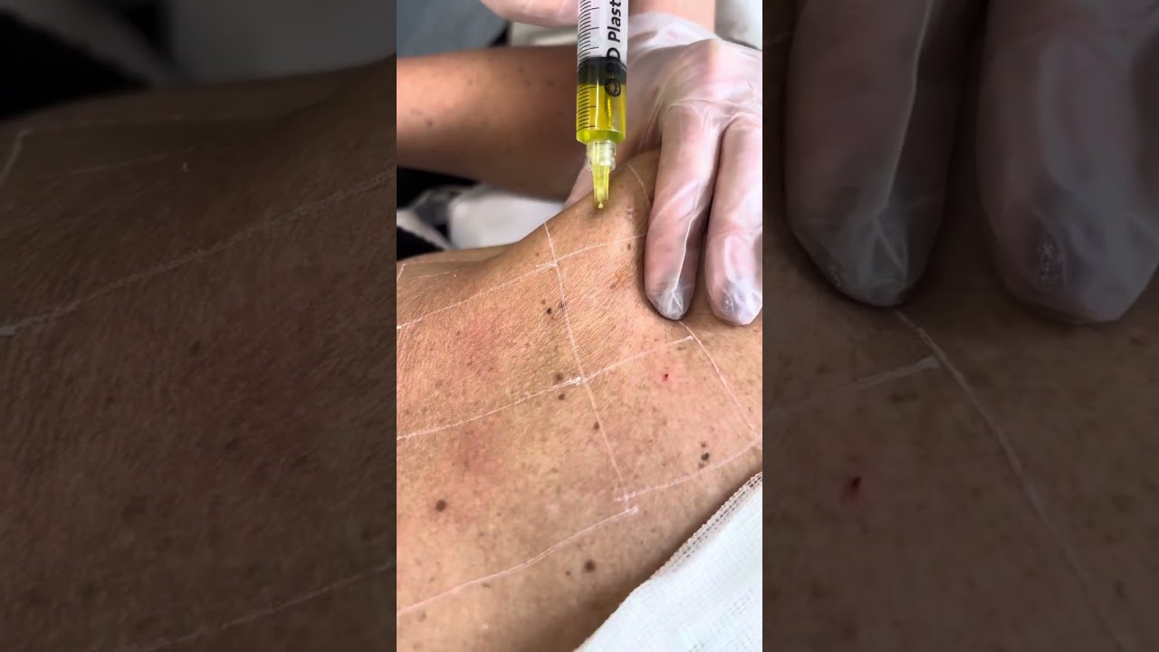 what size needle for lemon bottle fat dissolving Lemon Bottle Fat-Dissolving Injection ✓ buy online