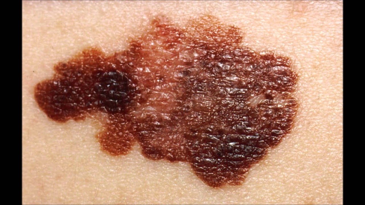 Skin cancer pictures YouTube