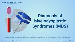 Diagnosis of Myelodysplastic Syndromes (MDS)