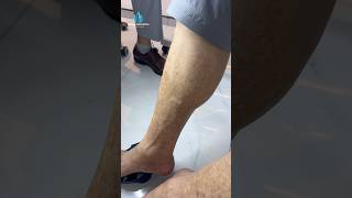 Schamberg Disease Explained | Cayenne Pepper Spots on Skin | #shorts