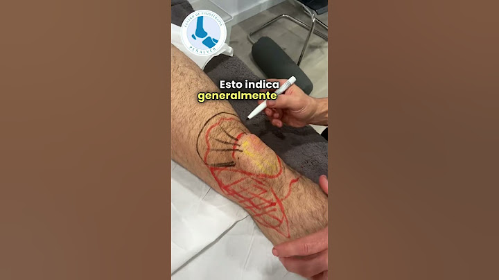 Inflamaciones en la Rodilla: ¿Qué Revelan sobre Tu Lesión? #fyp #viral #parati #fisioterapia