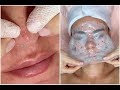 ASMR Organic Facial for Acne Oily Skin with Scars & Texture {+ Chemical Peel} | Jadeywadey180
