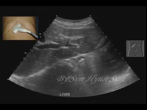 liver subcostal scan portal vein 1