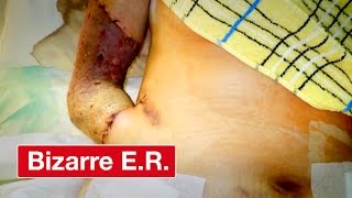 Sewing An Arm Into Stomach To Regrow Skin - Bizarre ER