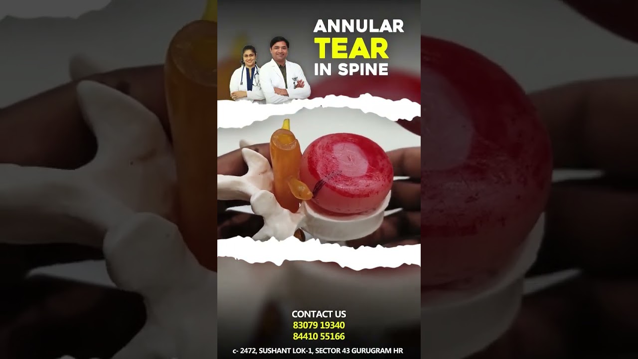Back Pain Treatment in Gurgaon | Annular Tear Cause & Non-Surgical Relief by Dr. Manohar lal 
