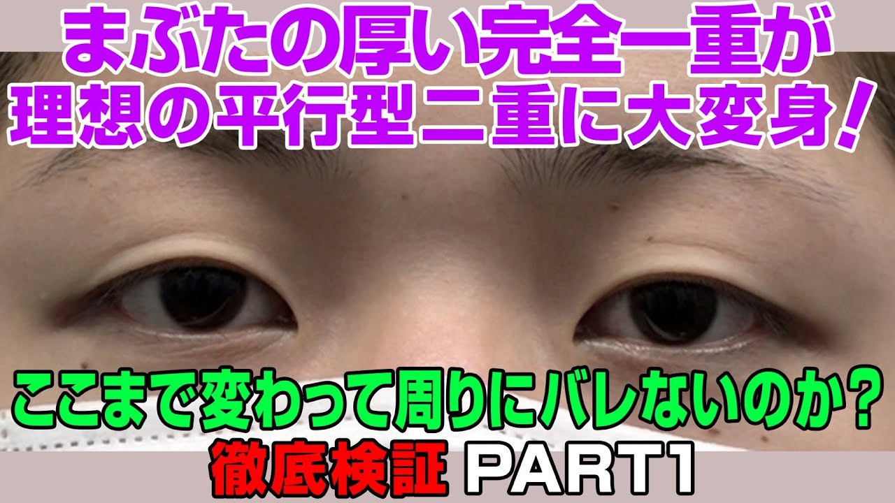 二重整形 完全一重に悩む女性が二重まぶた埋没法を受けて人に会っても バレない のか検証しました 湘南美容クリニック Youtube 二重整形 完全一重に悩む女性が二重まぶた埋没法を受けて人に会っても バレない のか検証しました 湘南美容クリニック Youtube