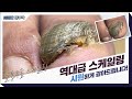 (Eng) 무좀발톱 치료/케어 안하고 오랫동안 방치한 케이스(ft. 스케일링) l Fungal/Ingrown toenails [NP케어]