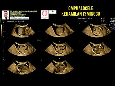 Video: Seberapa biasa omphalocele?