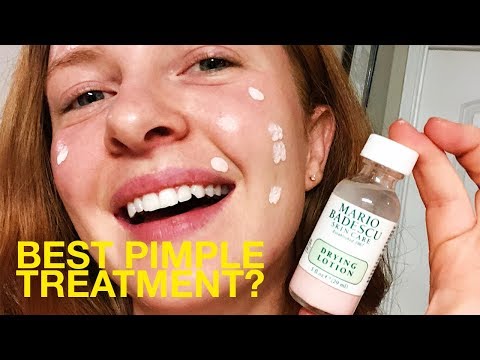 Best Pimple Spot Treatment? I Try Mario Badescu Drying Lotion