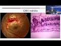 Aioc2022   ic5   topic   dr  jyotirmay biswas  uveitis   an insight in pathogenesis and pathology