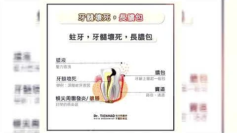 牙髓壞死 一定會長膿包嗎？ - 天天要聞