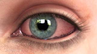 Bio-Tissues Amniograft For Conjunctivochalasis Cch