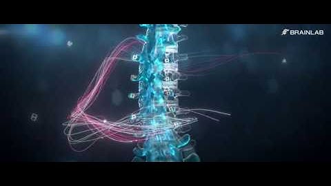 Brainlab Loop-X - NASS trade show (cut-down)