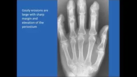"Gout and Pseudogout," Jeffrey Bieber, M.D.