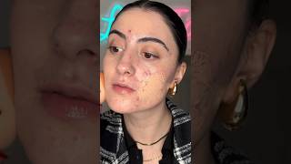 MAKEUP FOREVER HD GLOWY FOUNDATION ON ACNE/TEXTURED SKIN #acnepositivity #makeuptutorial #foundation