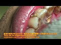 上尾 歯医者 歯周病 歯石取り動画 男性1 part8 หินปูน, ขูดหินปูน rटैटार, 韃靼 Tártaro