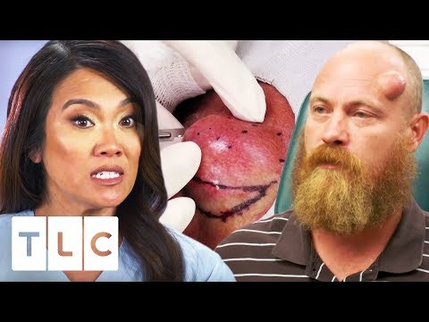 Dr. Lee Squeezes An 18 Year Old Cyst! | Dr. Pimple Popper