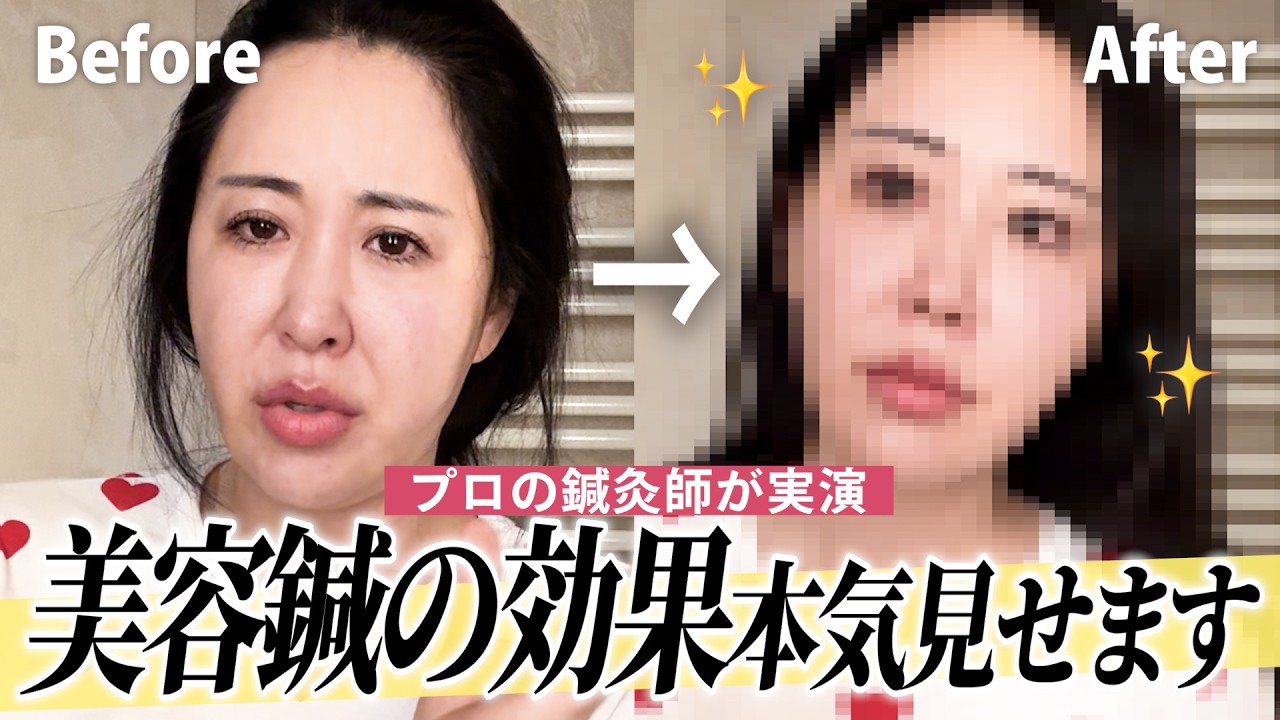 【激変】美容鍼の効果を鍼灸師が実演！疲れ顔・肌のハリ・もたつきが一瞬で改善するプロの神技✨ビフォーアフターが凄すぎる…🔥