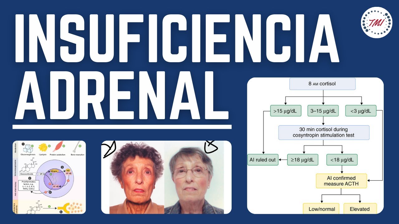 Insuficiencia Adrenal - Fisiopatología, Clínica, Diagnóstico, Tratamiento y Crisis Adrenal