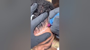 Scalp-Micropigmentation the complete first session!