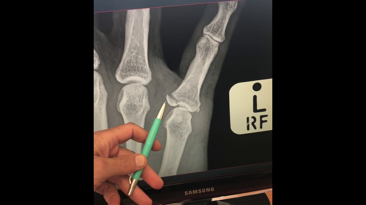 Ring Avulsion Injuries - Hand - Orthobullets