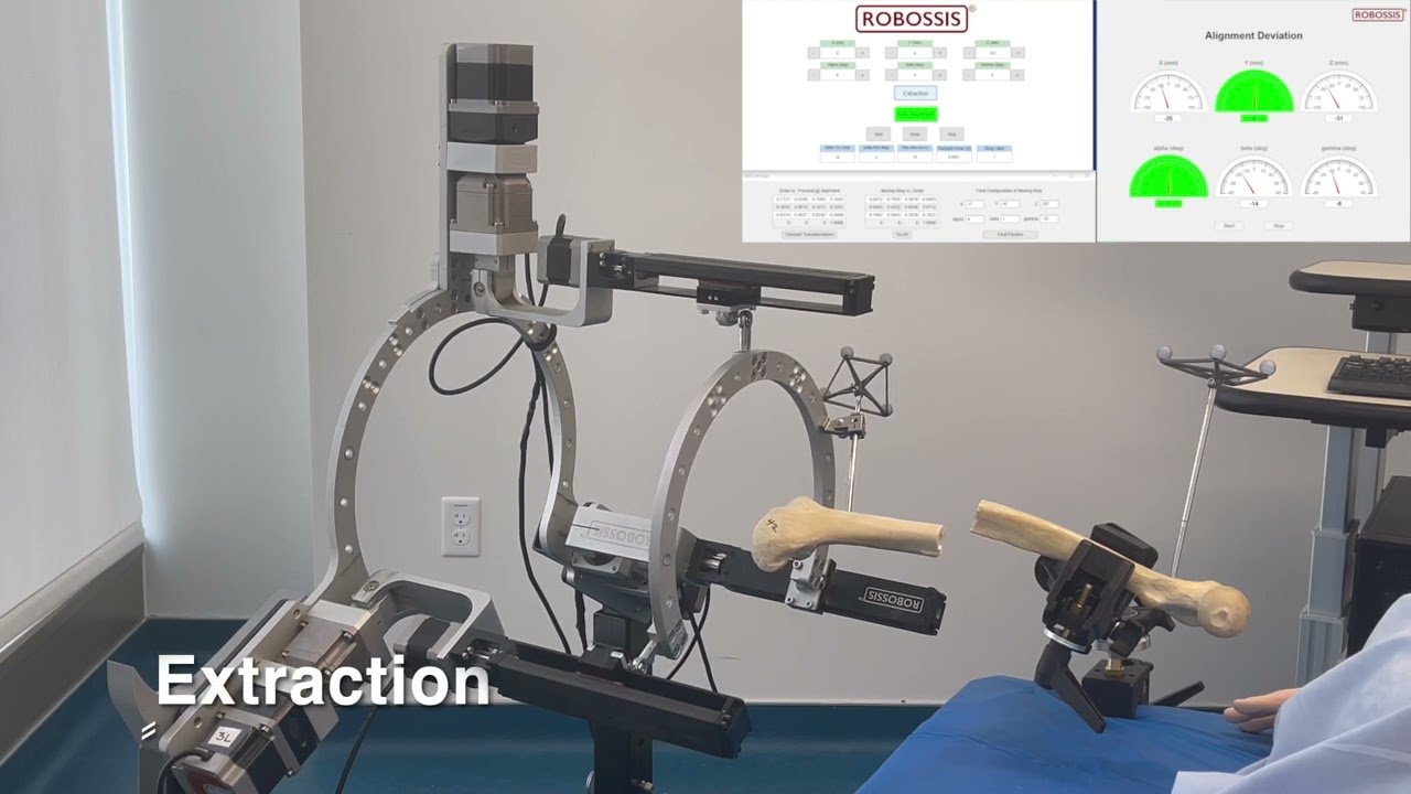 Robossis: Auto Alignment of the Fractured Femur
