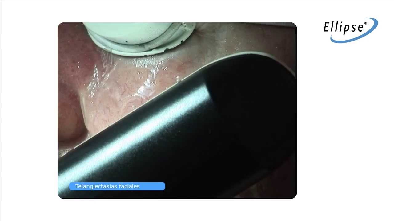 IPL: Tratamiento Telangiectasias faciales