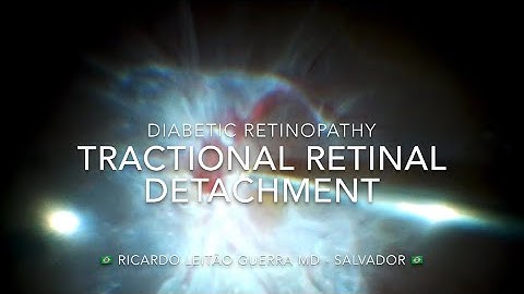 Tractional retinal detachment secondary diabetic retinopathy