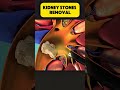 |Kidney stones removal| #KidneyStones #KidneyStoneRemoval #KidneyHealth