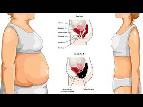 5 Ways to Get Rid of Bloating After a Large Meal!