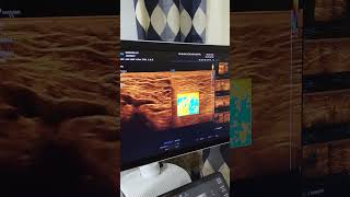 ultrasound breast axilla #ultrasound