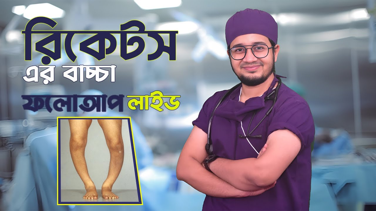 রিকেটস এর বাচ্চা এর ফলো আপ লাইভ | Rickets Treatment In Bangladesh | 