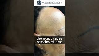 The Receding Mystery Of Frontal Fibrosing Alopecia
