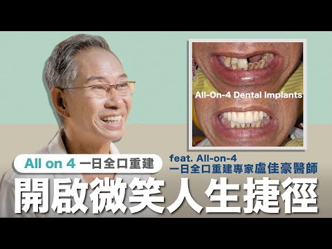 All-on-4 全口重建患者心得影片縮圖:開啟微笑人生捷徑,重新享受幸福「食」光