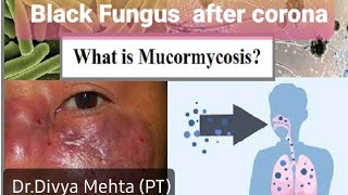 BLACK FUNGUS After Corona/ What is Mucormycosis