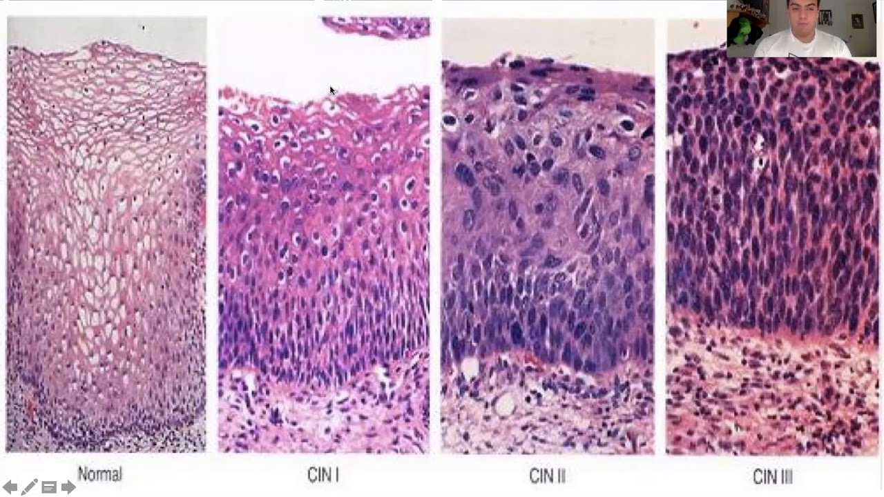 Дисплазия 1 степени шейки матки что это. Дисплазия шейки матки микропрепарат. Многослойный плоский эпителий шейки матки гистология. Дисплазия клеток плоского эпителия. Цин 1 шейки матки гистология.