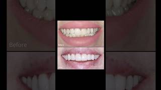 Smile Transformation! ✨ #SmileTransformation#BeforeAndAfter #SmileVirtualConsult#CosmeticDentistry Smile Transformation! ✨ #SmileTransformation#BeforeAndAfter #SmileVirtualConsult#CosmeticDentistry