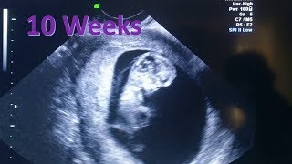 Ultrasound of Child Movement at 10 weeks
