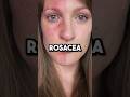 How to heal rosacea #health #rosacea #guthealth