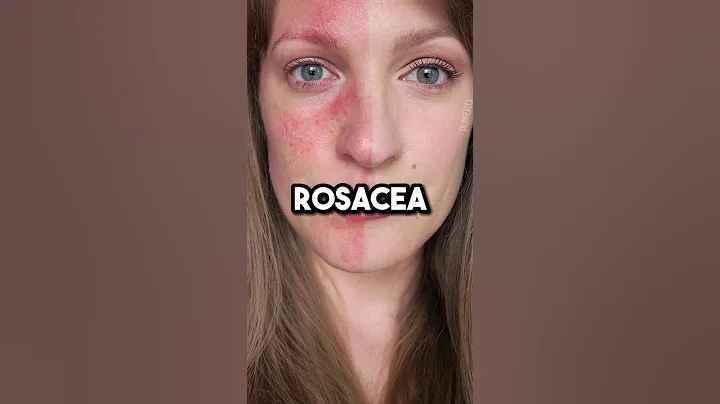 How to heal rosacea #health #rosacea #guthealth
