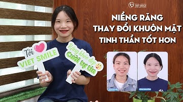 Niềng răng thay đổi khuôn mặt, tinh thần tốt hơn - KH Nguyễn Bích Thảo