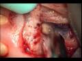 Dr jason deblinger root canal surgerymicroscopic apicoectomy lower anterior