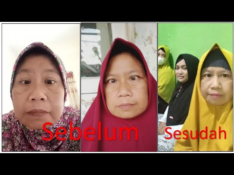 JULING DAN SEMPAT BUTA, OLAH NAPAS GLAUKOMA MEMPERBAIKI MATA SAYA
