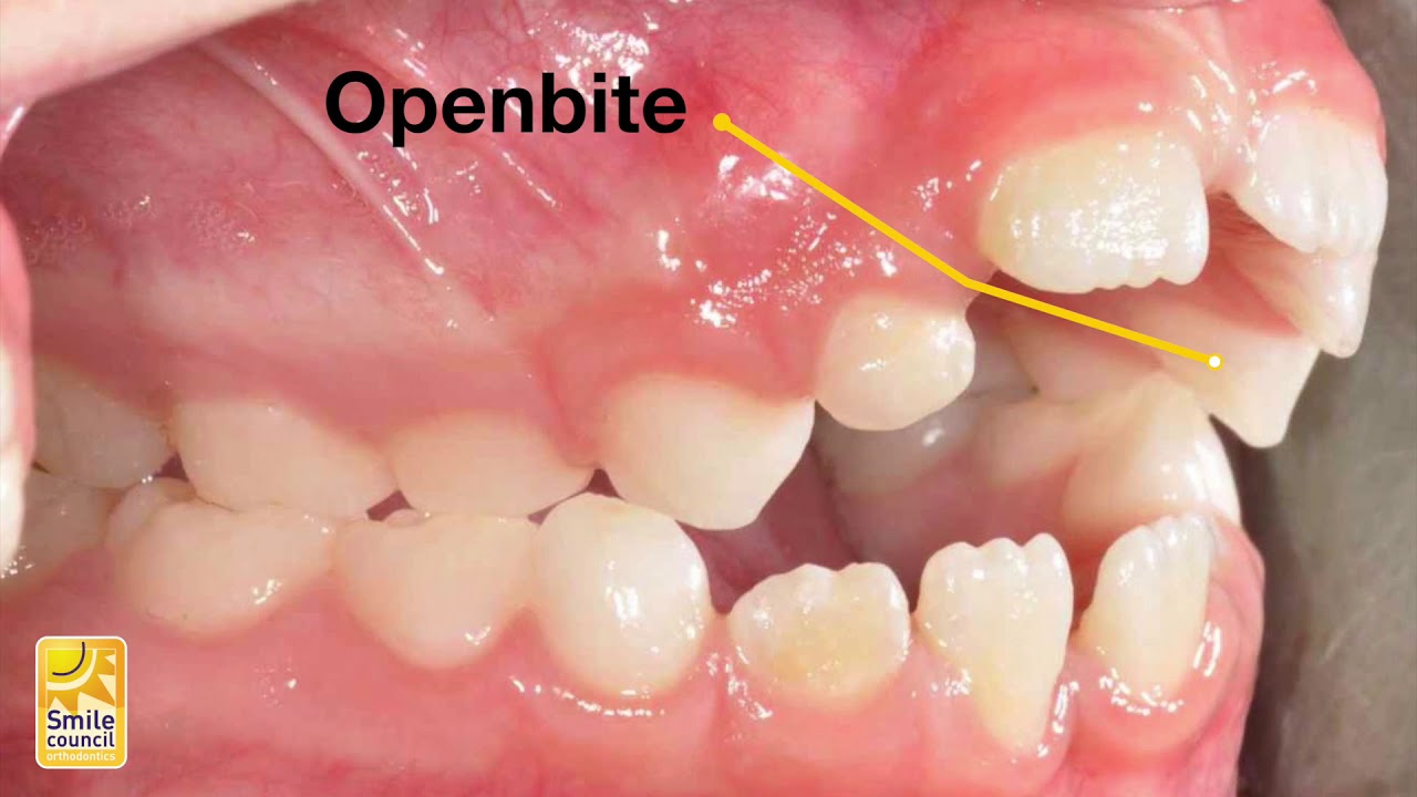 How Thumb Sucking Affects Childrens Teeth - Youtube-6350