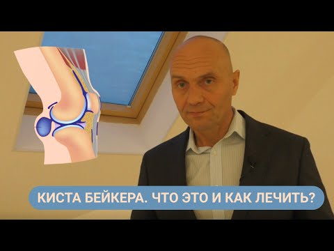 КИСТА БЕЙКЕРА. ЧТО ЭТО И КАК ЕЁ ЛЕЧИТЬ?